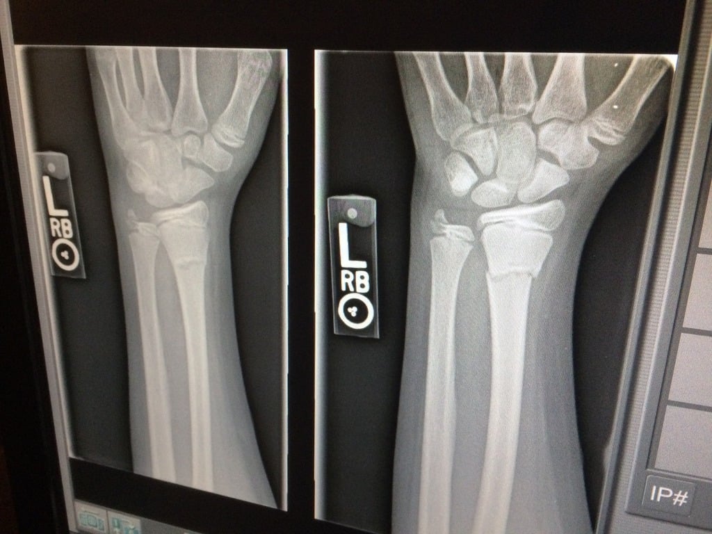 X-Ray